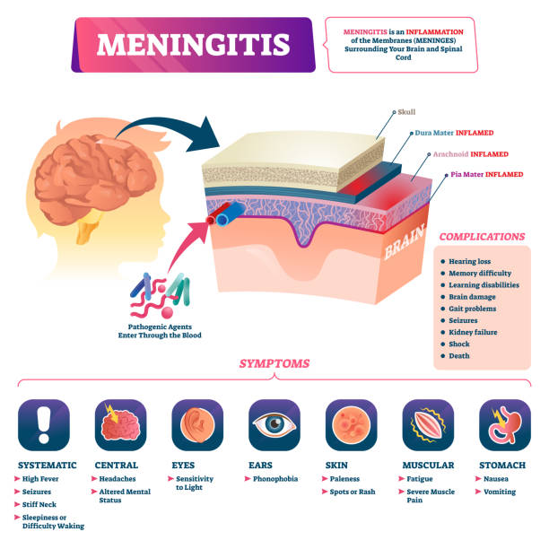 Cartoon Menigitis Rash 830+ Meningitis Stock Illustrations, Royalty-Free Vector Graphics ...