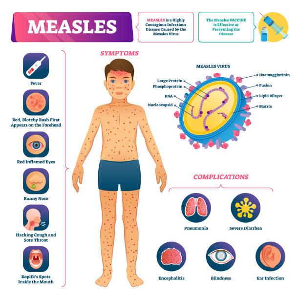 Measles vector illustration. Labeled medical virus disease medical scheme. Measles vector illustration. Labeled medical virus disease medical scheme. Anatomical symptoms, prevention and complications list. Educational infographic visualization. Contagious infection illness. measles stock illustrations