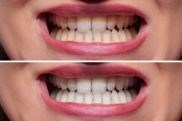 istock Person Teeth Before And After Whitening 1164645555
