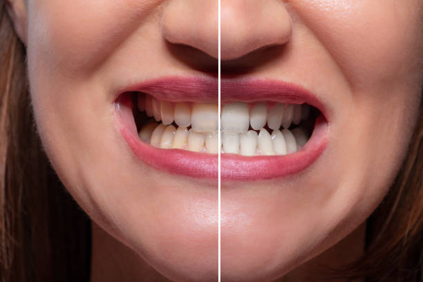 istock Person Teeth Before And After Whitening 1164645556