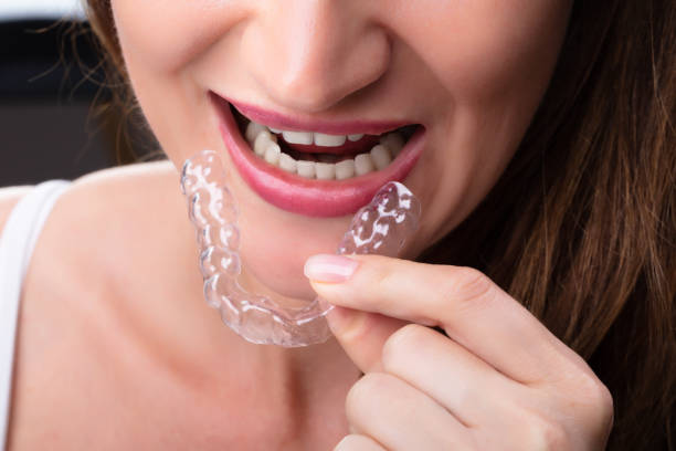 istock Woman Putting Transparent Aligner In Teeth 1164645571