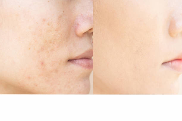 istock Acne scars and pores. Black spots, wrinkles and skin problems 1164655619