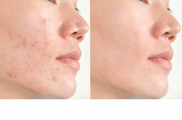 Acne scars and pores. Black spots, wrinkles and skin problems