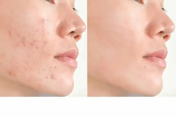 Photo of Acne scars and pores. Black spots, wrinkles and skin problems