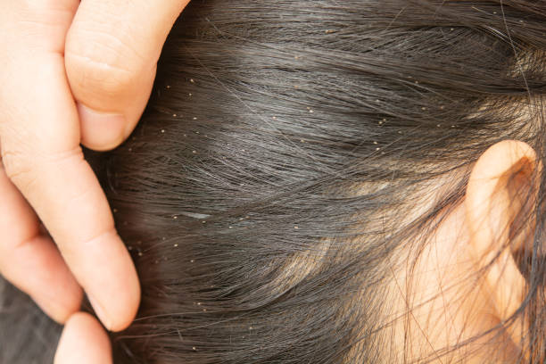 istock Lice in hair and comb on white background 1164659001