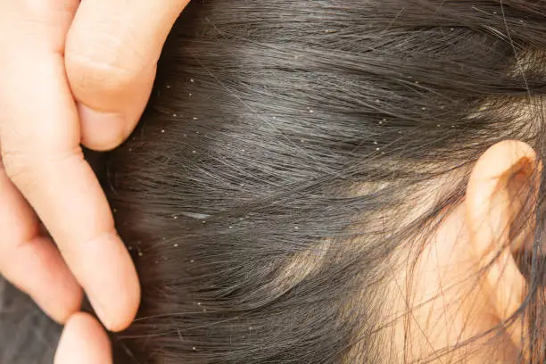 Photo of Lice in hair and comb on white background