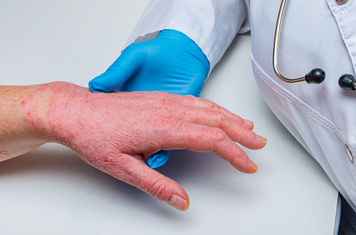 Un médico con guantes examina la piel de la mano de un paciente enfermo. Enfermedades crónicas de la piel - psoriasis, eczema, dermatitis. photo