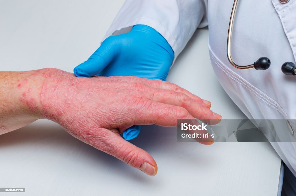 A doctor in gloves examines the skin of the hand of a sick patient. Chronic skin diseases - psoriasis, eczema, dermatitis. doctor in gloves examines the skin of the hand of a sick patient. Chronic skin diseases - psoriasis, eczema, dermatitis. Psoriasis Stock Photo