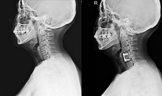 x-ray cervical spine (LATERAL Views) before and after 0peretion spinal fication of C5-6 bodies Showing No spinal dislocation.Medical concept