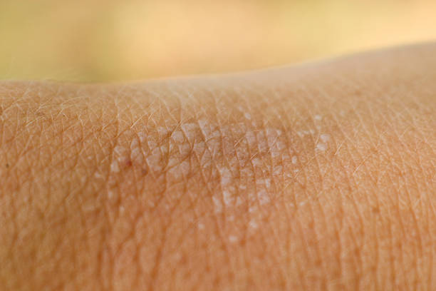 istock Blisters on human skin on the hand from sunburn close-up. Macro. 1164733368