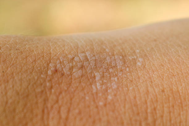 Blisters on human skin on the hand from sunburn close-up. Macro. Blisters on human skin on the hand from sunburn close-up. Macro. leprosy stock pictures, royalty-free photos & images