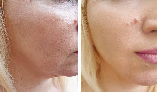 istock woman face wrinkles before and after correction 1164742552