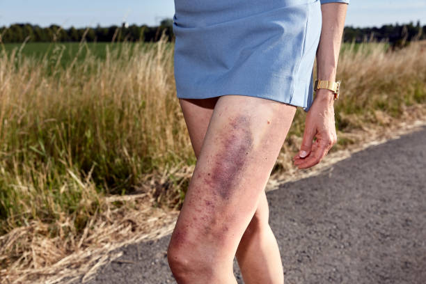 Bruise on the thigh of a woman stock photo