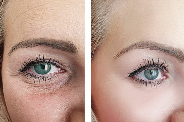 istock woman face wrinkles before and after correction 1164759110