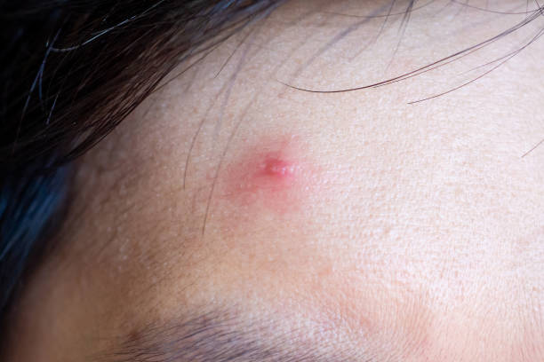 istock Inflammatory acne with red spot on face closeup 1164802183