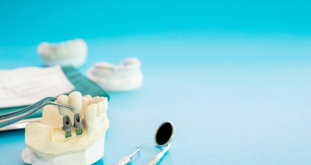 istock Implant and prosthodontic model. 1164849272