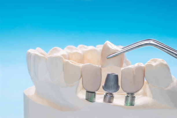 istock Close up implant and prosthodontic model. 1164849321