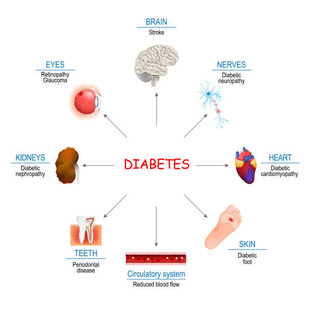Diabetes Affects and Complications Diabetes Affects. Complications of diabetes mellitus: nephropathy, Diabetic foot, neuropathy, retinopathy, stroke; Reduced blood flow and cardiomyopathy. Vector diagram for educational, medical use heart kidney disease stock illustrations