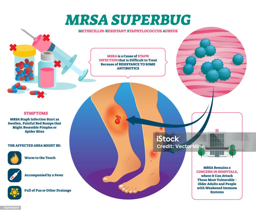 MRSA Super Bug Vektor Illustration. Beschriftete Staph-Infektion erklären Schema. - Lizenzfrei MRSA Vektorgrafik