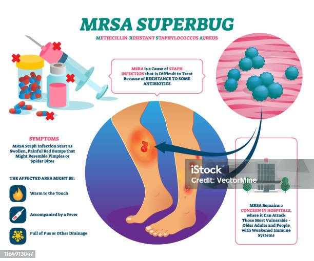 Mrsa Super Bug Vektor Illustration Beschriftete Staphinfektion Erklären Schema Stock Vektor Art und mehr Bilder von MRSA