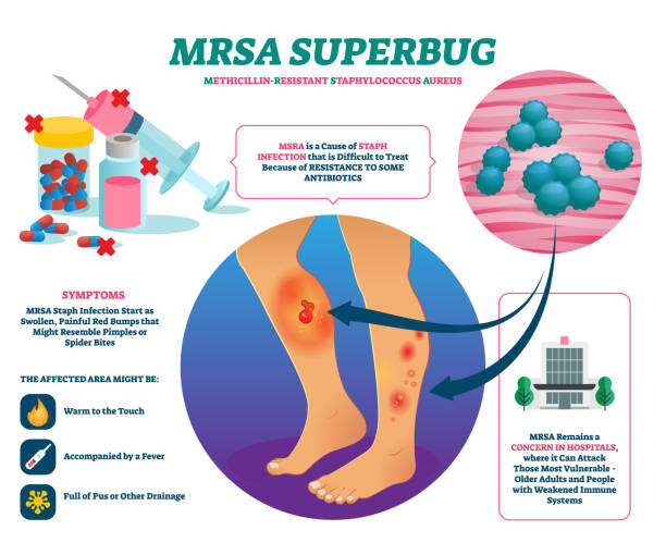 ilustraciones, imágenes clip art, dibujos animados e iconos de stock de ilustración vectorial de super bug mrsa. esquema de explicación de infección por estafilococos etiquetado. - mrsa bacterium streptococcus staphylococcus