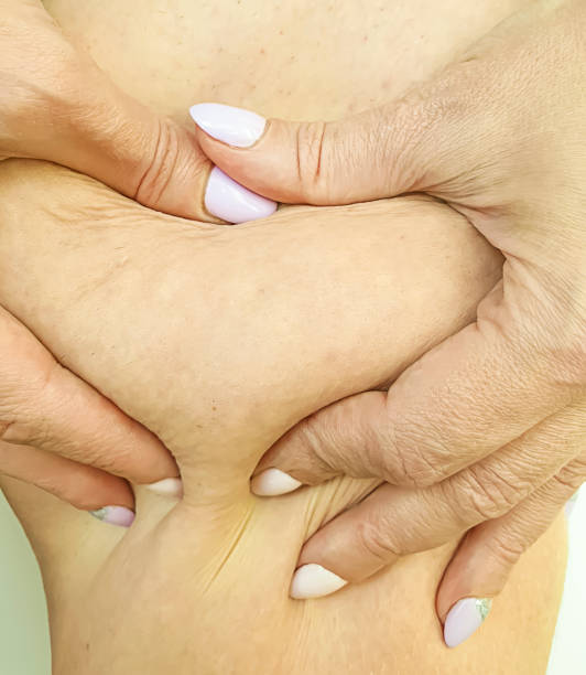 istock woman showing cellulite on legs close up 1164967945