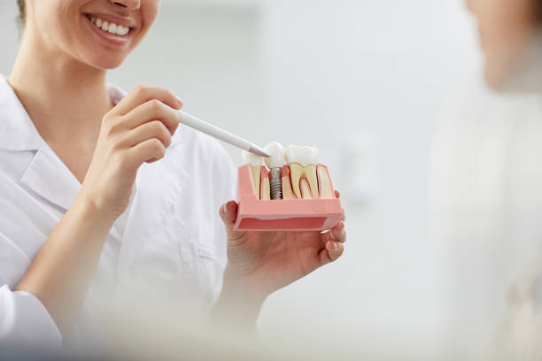 dentista sorridente che spiega l'impianto dentale - impianto dentale foto e immagini stock