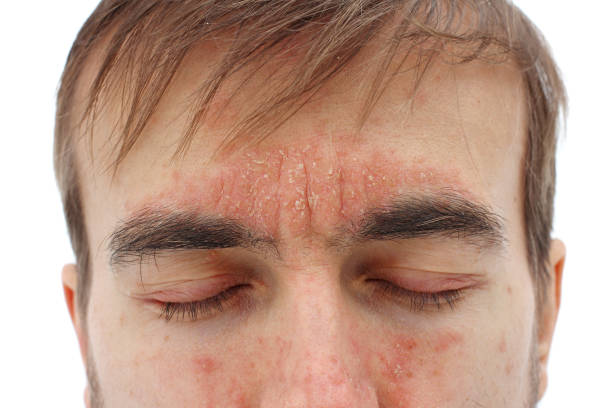 皮膚、鼻、額および頬の赤いアレルギー反応、赤いアレルギー反応を持つ目を閉じた病気の男性の頭、季節の皮膚の問題、クローズアップ、白い背景 - human skin dry human face peeling ストックフォトと画像