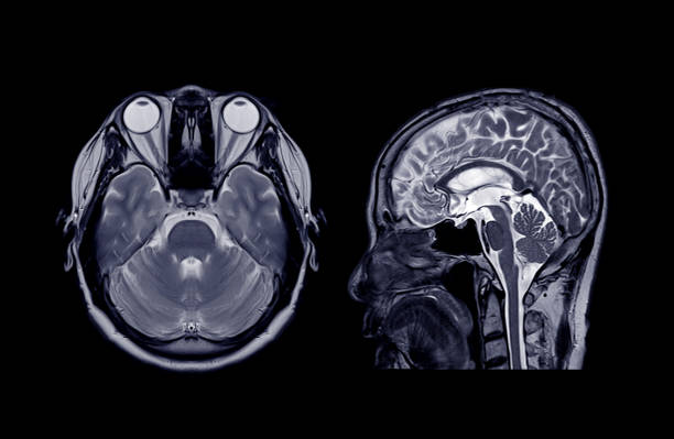 rmn del cerebro axial y plano coronal para detectar la enfermedad cerebral. - mri scan human nervous system brain medical scan fotografías e imágenes de stock