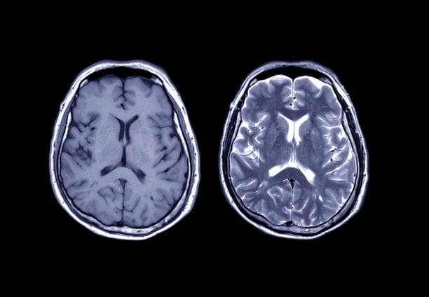 Comparison MRI brain Axial T1 and T2  for detect a variety of conditions of the brain such as cysts, tumors, bleeding, swelling, developmental and structural abnormalities, infections. stock photo