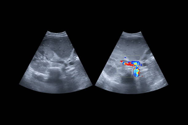 ultrasound upper abdomen showing flow in common bile duct  before and after use color doppler. clipping path. - human upper body xray imagens e fotografias de stock
