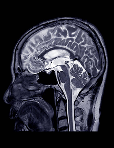 resonancia magnética del plano sagital cerebral. - mri scan human nervous system brain medical scan fotografías e imágenes de stock
