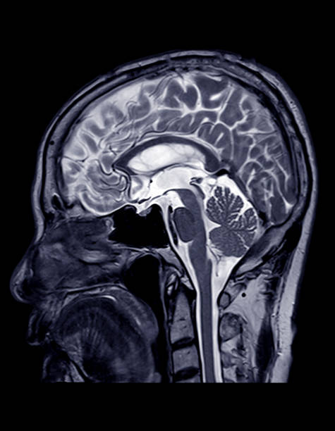 istock MRI of the brain sagittal plane. 1165138045