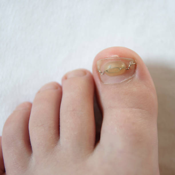 Onychocryptosis: an ingrown toenail treated with a nail clamp. stock photo