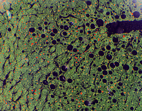 Liver fatty degeneration view under microscopy, shows the circle fat deposit