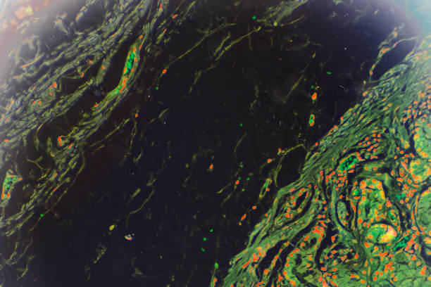 istock Gastric mucosa intestinal metaplasia under microscopy 1165408857
