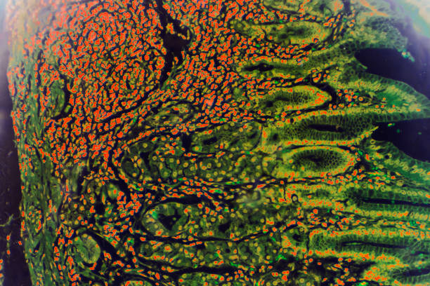 istock Gastric mucosa intestinal metaplasia under microscopy 1165408956