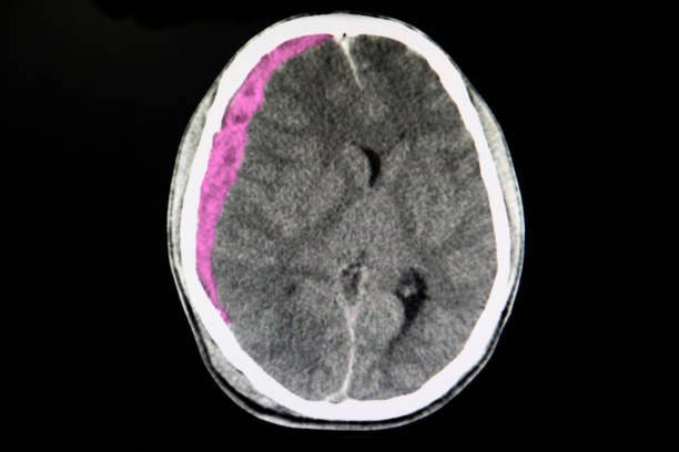 A CT scan of the trauma patient with brain hemorrhage A CT scan of the brain of a patient with trafic accident showing acute subdural hematoma. Intracerebral hemorrhage. hematoma images stock pictures, royalty-free photos & images