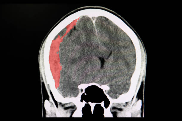 A CT scan of the trauma patient with brain hemorrhage A CT scan of the brain of a patient with trafic accident showing acute subdural hematoma. hematoma images stock pictures, royalty-free photos & images