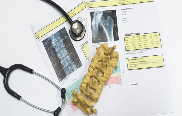 istock bone density hip and lumbarspine Result Osteoporosis 1165489456