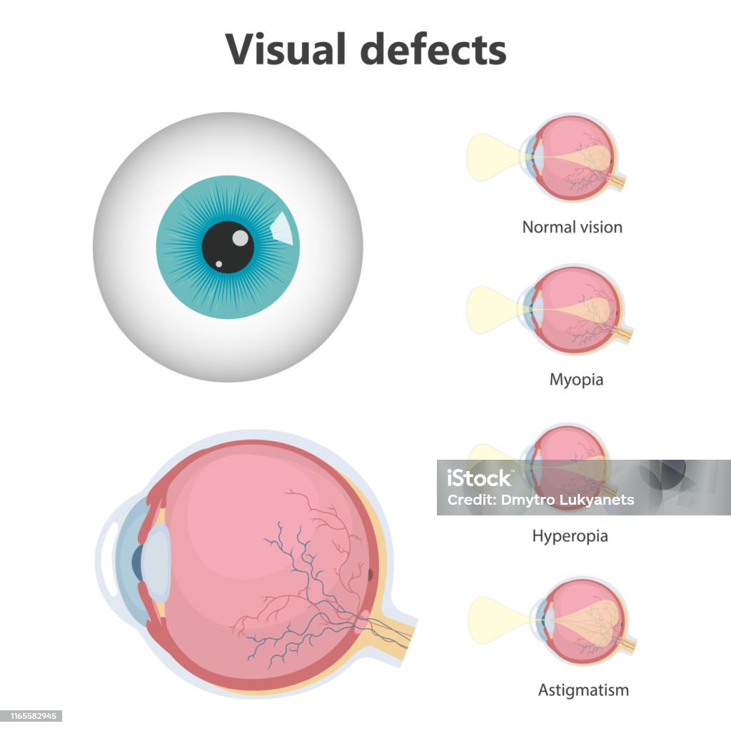 Defects In Vision Eye Defects Stock Illustration - Download Image Now - Anatomy ...