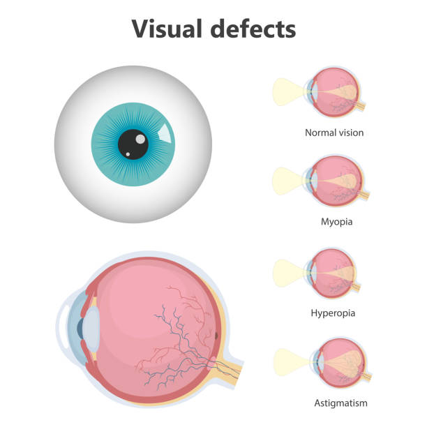 Basic Eye Defects 180+ Eye Defects Stock Photos, Pictures & Royalty-Free Images - iStock