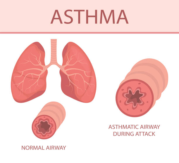 폐 계통의 질병 - 천식 호흡기 stock illustrations