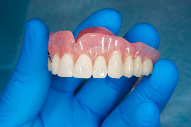 nahaufnahme menschlicher prothese des oberkiefers auf blauem hintergrund in der hand eines zahnarztes, der einen medizinischen handschuh trägt - dentures stock-fotos und bilder