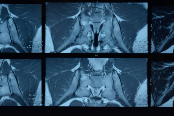 mri sacroiliac 관절. 강직성 척추 관절염 환자의 연구. - x ray image x ray back low 뉴스 사진 이미지