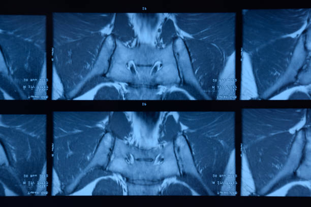 mri sacroiliac 관절. 강직성 척추 관절염 환자의 연구. - x ray image x ray back low 뉴스 사진 이미지