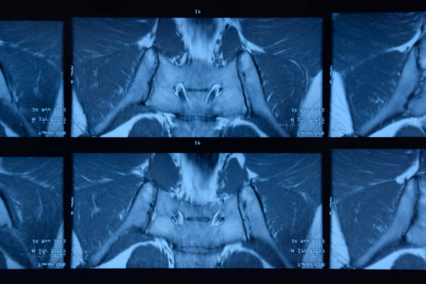 articulação sacroilíaca de rm. estudo do paciente anquilososo do espondiloartrite. - x ray image x ray back low - fotografias e filmes do acervo