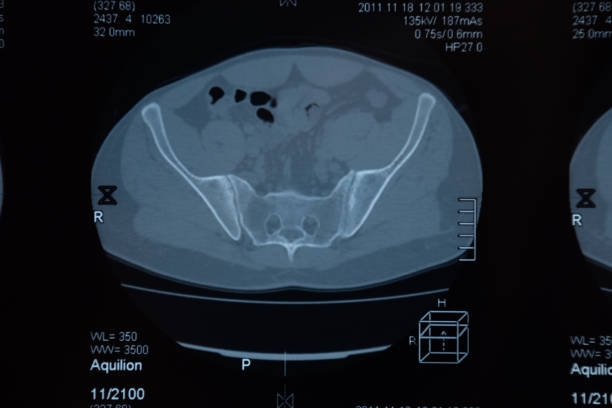istock MRI sacroiliac articulation. Study of ankylosing spondyloarthritis patient. 1165646944