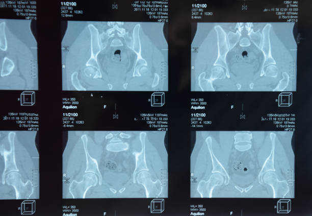 mri sacroiliac 관절. 강직성 �척추 관절염 환자의 연구. - x ray image x ray back low 뉴스 사진 이미지