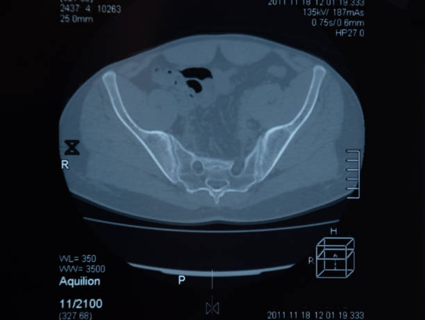 mri sacroiliac 관절. 강직성 척추 관절염 환자의 연구. - x ray image x ray back low 뉴스 사진 이미지